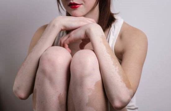 vitiligo